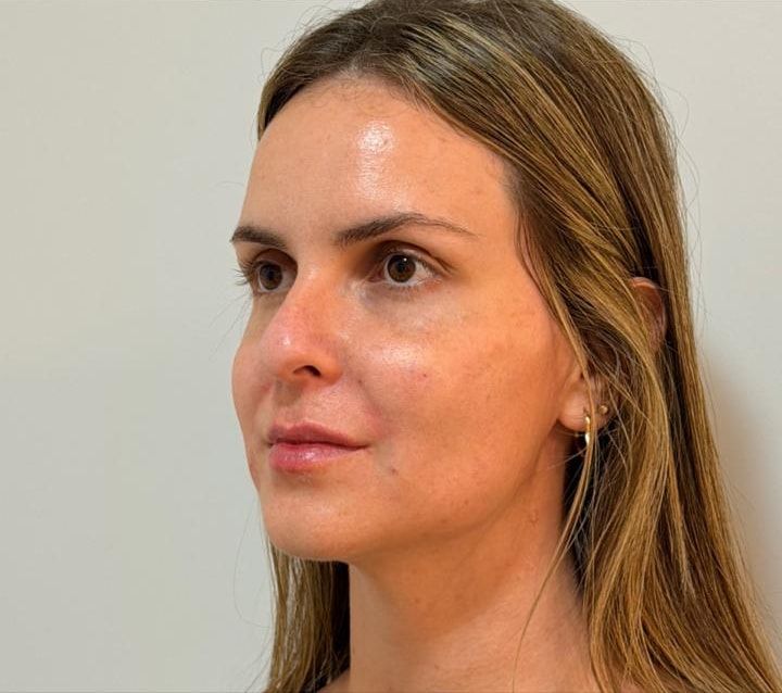 Depois: rosto de três quartos de uma paciente