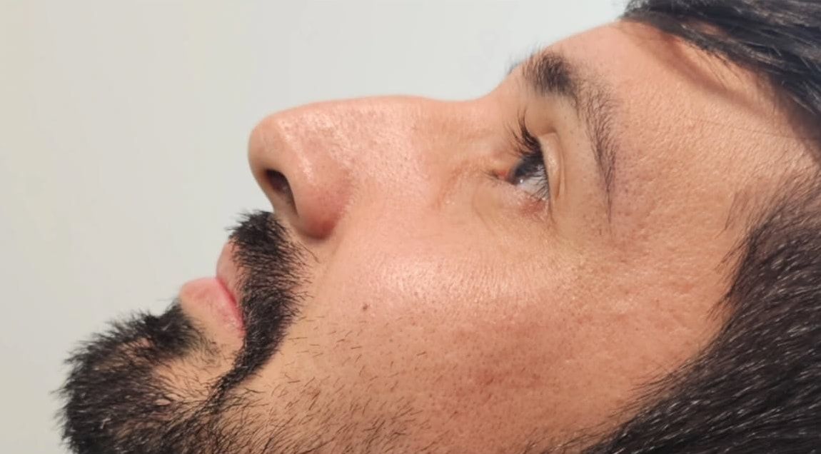 Antes: perfil do nariz de um paciente
