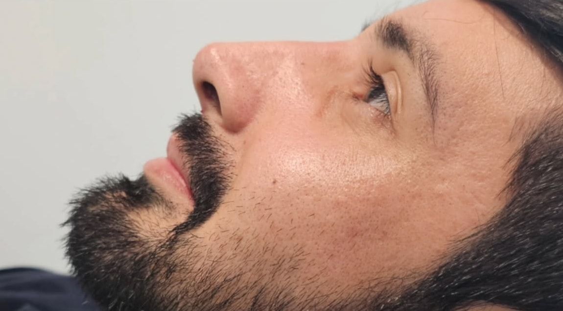 Depois: perfil do nariz de um paciente